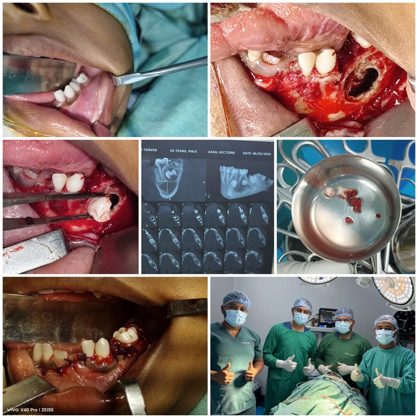 Cyst enucleation of lower jaw